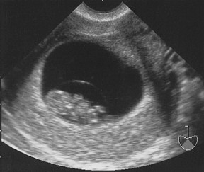 baby_9wks_pre.jpg